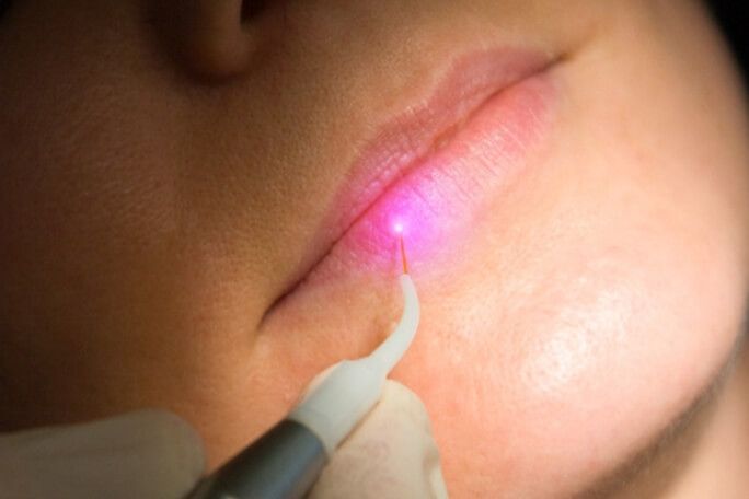 Ask us about laser treatment for cold sores!
